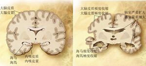 Alzheimer's disease brain comparison-zh.jpg